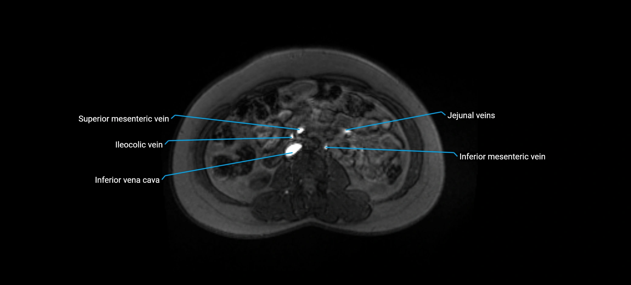 MRV abdomen pelvis & lower limb axial cross sectional anatomy labelled MRI image 88 (1).webp